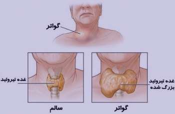 پرکاری تیروئید و ریزش مو , علایم پرکاری تیروئید , تیروئید و ریزش مو پرکاری تیروئید و ریزش مو , علایم پرکاری تیروئید , تیروئید و ریزش مو
