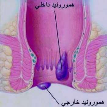 بواسیر و زایمان طبیعی , درمان بواسیر در بارداری , یواسیر در بارداری بواسیر و زایمان طبیعی , درمان بواسیر در بارداری , یواسیر در بارداری