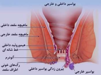 بواسیر و خون در مدفوع , درمان بواسیر و خون در مدفوع , علت بواسیر و خون در مدفوع بواسیر و خون در مدفوع , درمان بواسیر و خون در مدفوع , علت بواسیر و خون در مدفوع