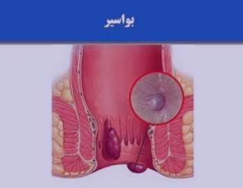 درمان بواسیر با زالو , درمان بواسیر , زالو برای بواسیر