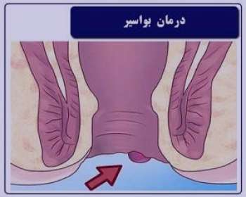 درمان بواسیر با زالو , درمان بواسیر , زالو برای بواسیر