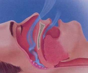 آلرژی و تنگی نفس , درمان آلرژی و تنگی نفس , علائم آلرژی