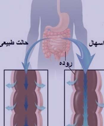 دلایل اسهال مزمن , علت اسهال مزمن , درمان اسهال مزمن
