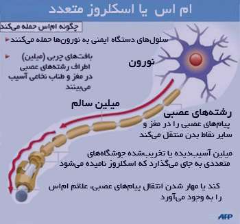 Image result for ‫بیماری ام اس چیست‬‎