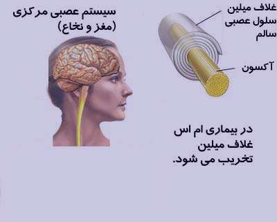 Image result for ‫بیماری ام اس چیست‬‎