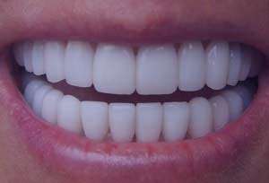 حساسیت دندان, درمان حساسیت دندانی حساسیت دندان, درمان حساسیت دندانی