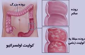 بیماری کوليت اولسراتيو, کولیت زخمی شونده بیماری کوليت اولسراتيو, کولیت زخمی شونده