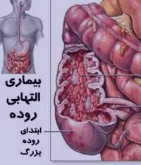 بیماری کوليت اولسراتيو, کولیت زخمی شونده بیماری کوليت اولسراتيو, کولیت زخمی شونده