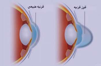 قوز قرنیه, بیماریهای چشمی, ناهنجاریهای قرنیه قوز قرنیه, بیماریهای چشمی, ناهنجاریهای قرنیه