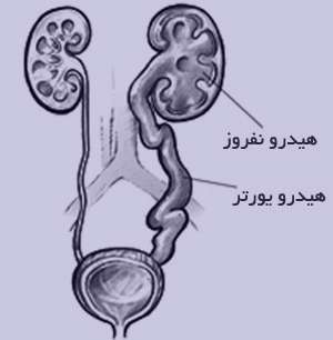 عفونتهاي ادراري, علائم ريفلاکس ادراري