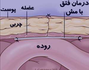 فتق,بیماری فتق درد فتق ،درد فتق شکمی،درد فتق بیضه،درد فتق در مردان،درد فتق ناف،درد فتق کشاله ران،درد فتق در زنان