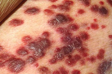 ایدز چیست , ایدز چیست؟ ویکی پدیا , ایدز چیست و علائم آن , ایدز چیست علایم ایدز چیست , ایدز چیست؟ ویکی پدیا , ایدز چیست و علائم آن , ایدز چیست علایم