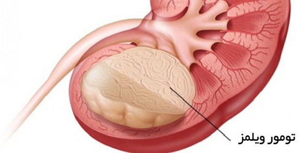 تومور ویلمز , تومور ویلمز کلیه کودکان , تومور ویلمز کلیه , تومور ویلمز Ppt تومور ویلمز , تومور ویلمز کلیه کودکان , تومور ویلمز کلیه , تومور ویلمز Ppt