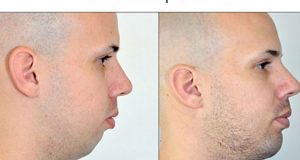 عوارض انواع جراحی و پروتز چانه و فک با تزریق ژل چیست و چگونه است