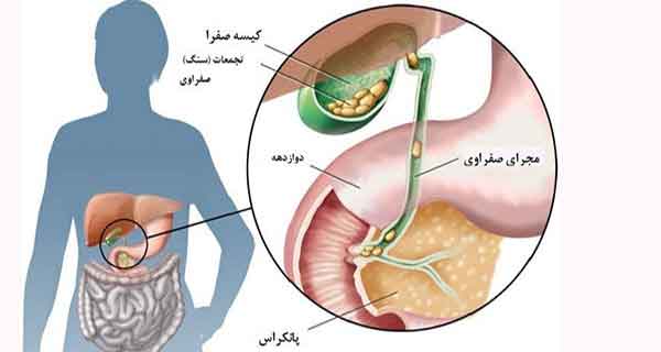 سرطان صفرا , سرطان صفراوی , سرطان مجاری صفراوی , سرطان کیسه صفرا کشنده است