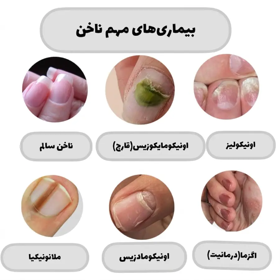 ایجاد قارچ در کاشت ناخن